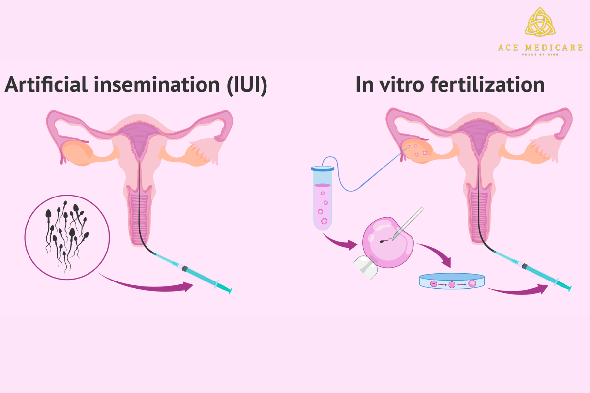 IUI Vs. IVF : An explanation of two popular fertility treatments